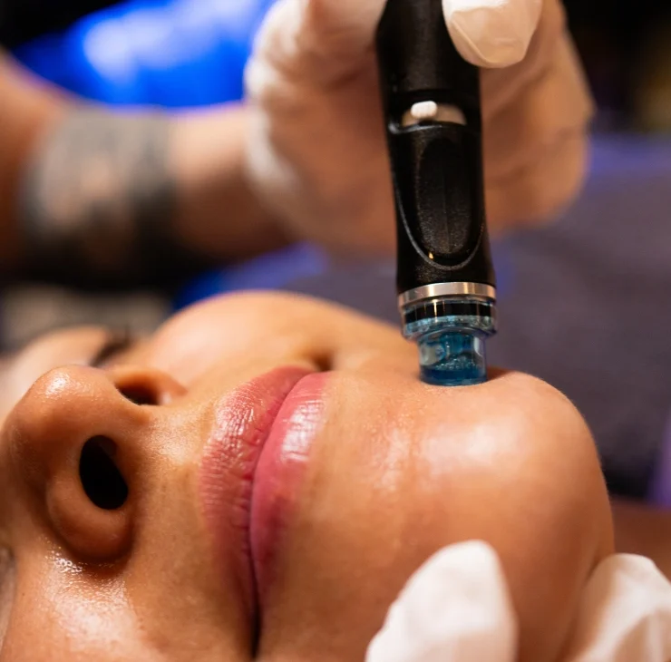 hydrafacial bilbao